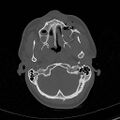 Base of skull fracture with bilateral Le Fort fractures (Radiopaedia 47094-51638 Axial bone window 20).jpg