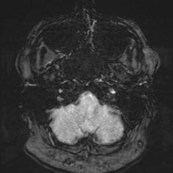 File:Basilar artery dissection (Radiopaedia 77032-88976 Axial SWI 7).jpg