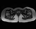 Bicornuate bicollis uterus (Radiopaedia 61626-69616 Axial T2 38).jpg