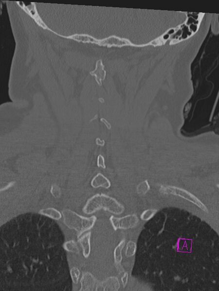 File:Bilateral atlanto-occipital assimilation (Radiopaedia 28350-28603 Coronal bone window 36).jpg