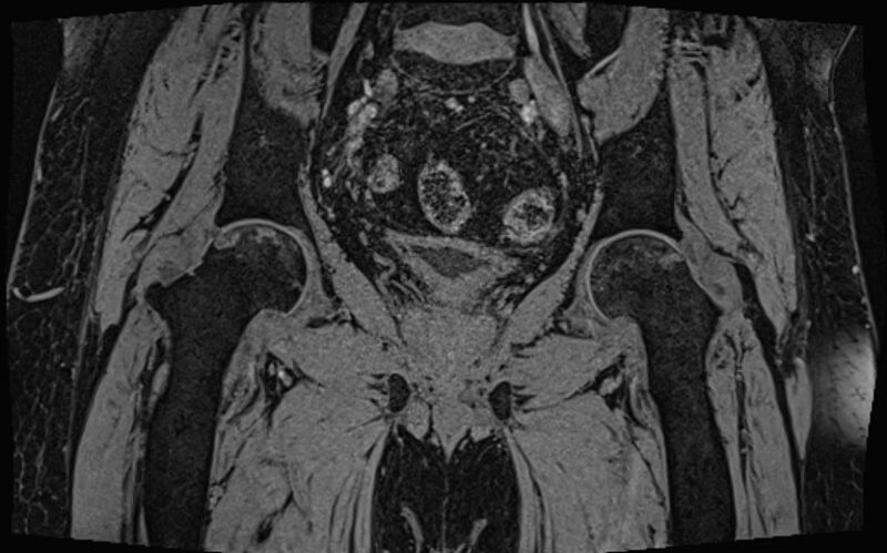 File:Bilateral avascular necrosis of femoral head (Radiopaedia 77116-89078 Coronal T2 we 35).jpg