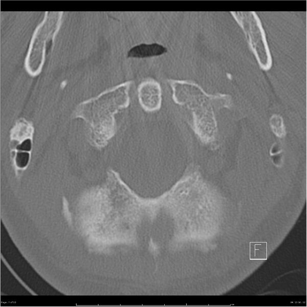 File:Bilateral cervical ribs (Radiopaedia 25868-26017 Axial bone window 7).jpg