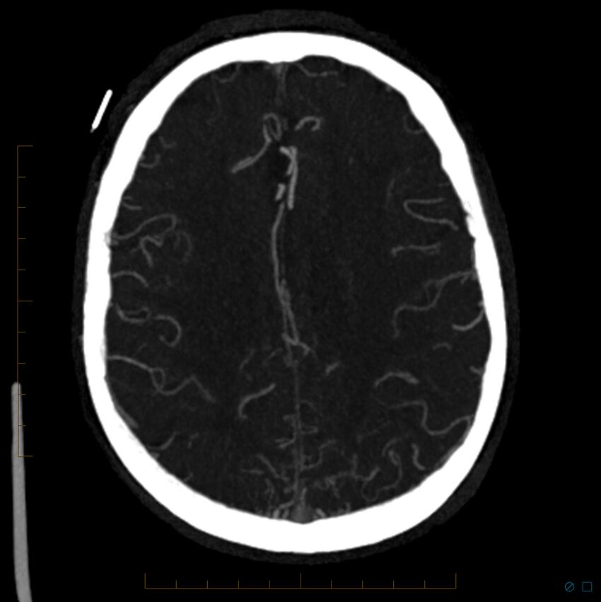 Bilateral chronic common carotid occlusion (Radiopaedia 50849-56362 D 10).jpg