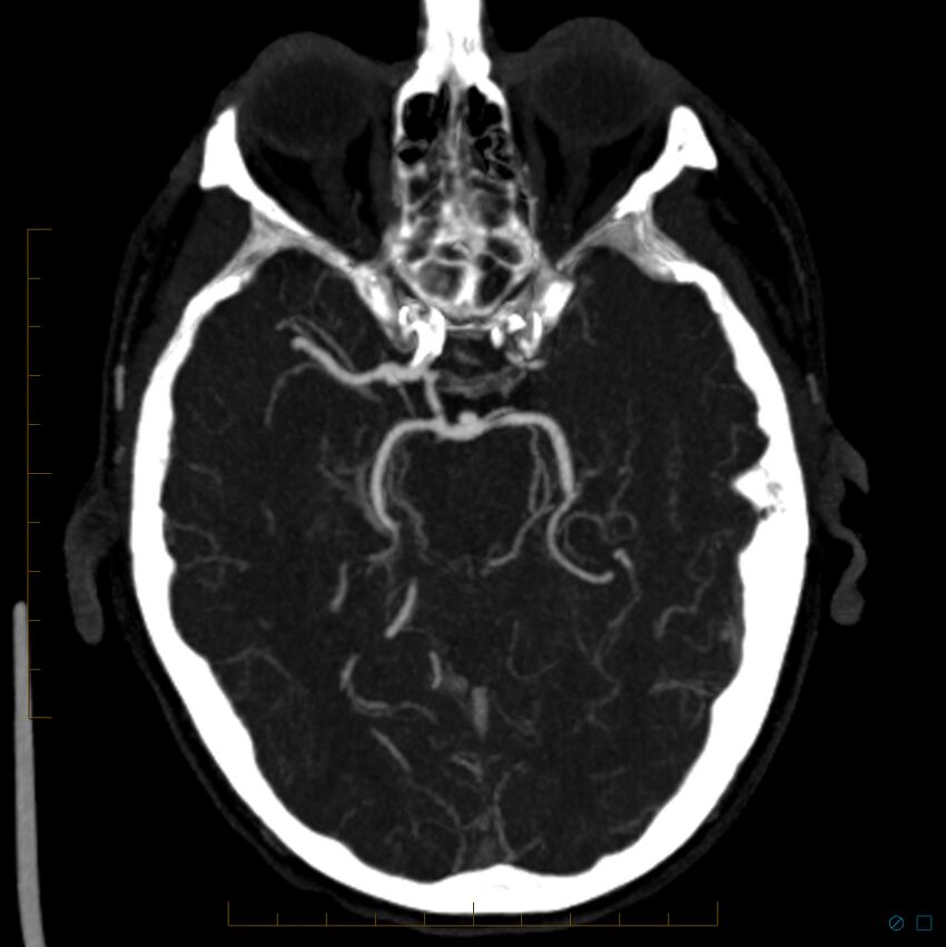 Bilateral chronic common carotid occlusion (Radiopaedia 50849-56362 D 19).jpg