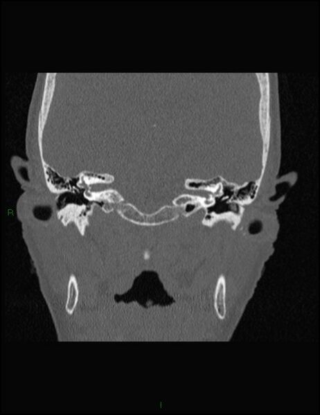 File:Bilateral frontal mucoceles (Radiopaedia 82352-96454 Coronal 302).jpg