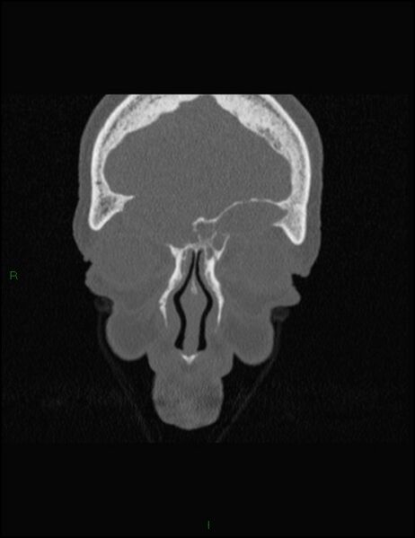 File:Bilateral frontal mucoceles (Radiopaedia 82352-96454 Coronal 76).jpg