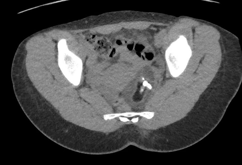 File:Bilateral mature cystic ovarian teratoma (Radiopaedia 88821-105592 Axial non-contrast 23).jpg