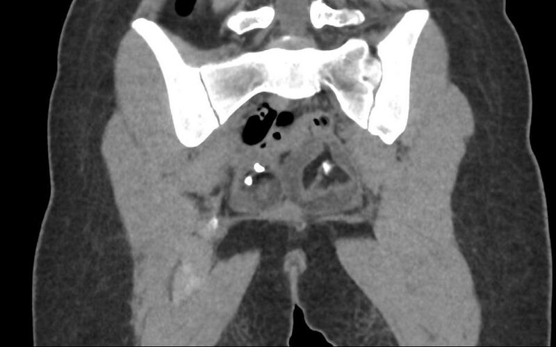 File:Bilateral mature cystic ovarian teratoma (Radiopaedia 88821-105592 Coronal non-contrast 29).jpg