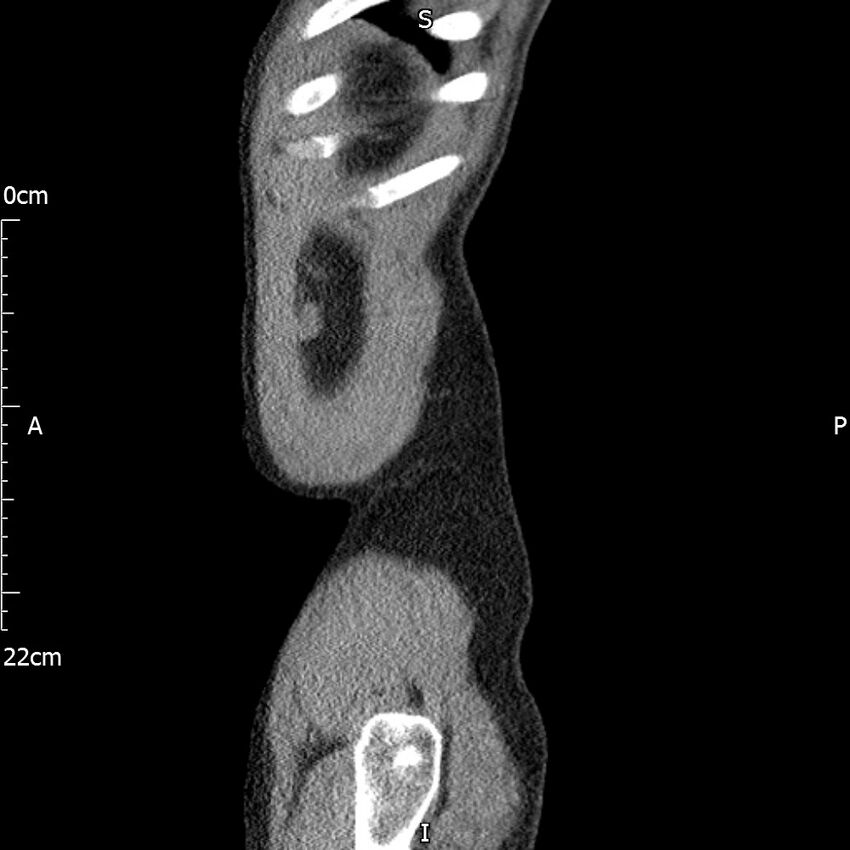 Bilateral medullary nephrocalcinosis with ureteric calculi (Radiopaedia 71269-81569 C 13).jpg