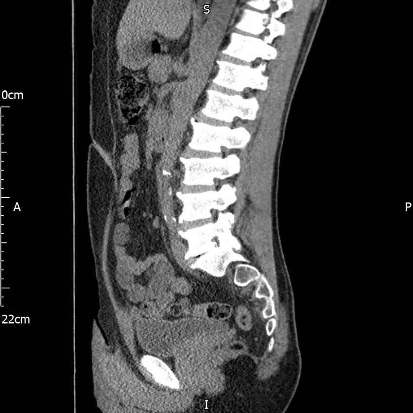 Bilateral medullary nephrocalcinosis with ureteric calculi (Radiopaedia 71269-81569 C 55).jpg