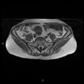 Bilateral ovarian fibroma (Radiopaedia 44568-48293 Axial T1 4).jpg