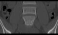 Bilateral pars defect (Radiopaedia 26691-26846 Coronal bone window 13).jpg