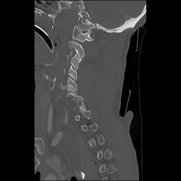 File:Bilateral perched facets with cord injury (Radiopaedia 45587-49713 Sagittal bone window 15).jpg