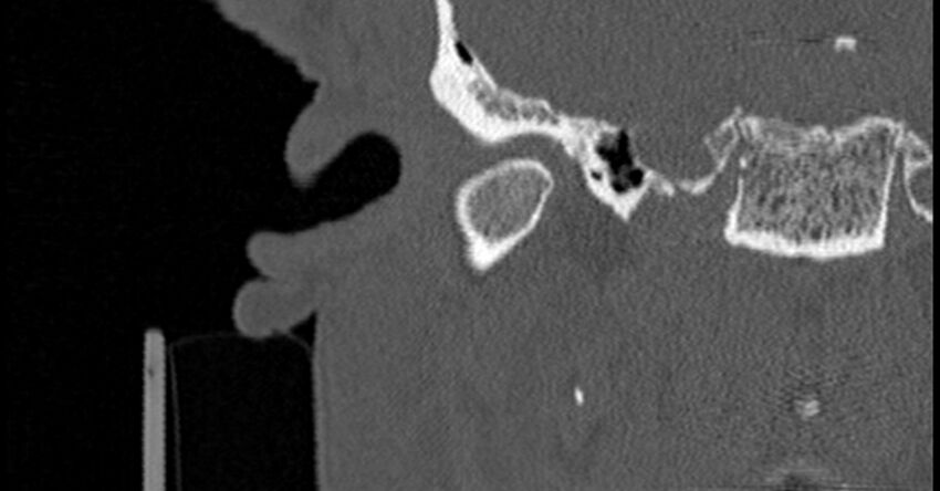 Bilateral temporal bone fractures (Radiopaedia 29482-29970 Coronal non-contrast 65).jpg