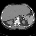 Biliary necrosis - liver transplant (Radiopaedia 21876-21845 A 14).jpg