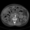 Biliary necrosis - liver transplant (Radiopaedia 21876-21846 A 35).jpg