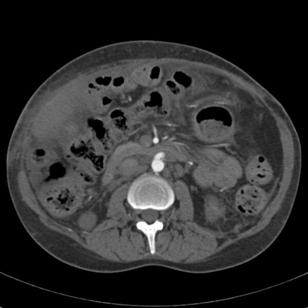 File:Biliary necrosis - liver transplant (Radiopaedia 21876-21846 A 35).jpg