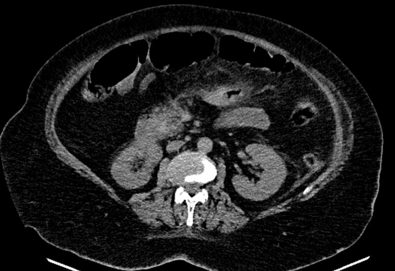 File:Biliary pancreatitis (Radiopaedia 72289-82823 Axial non-contrast 124).jpg