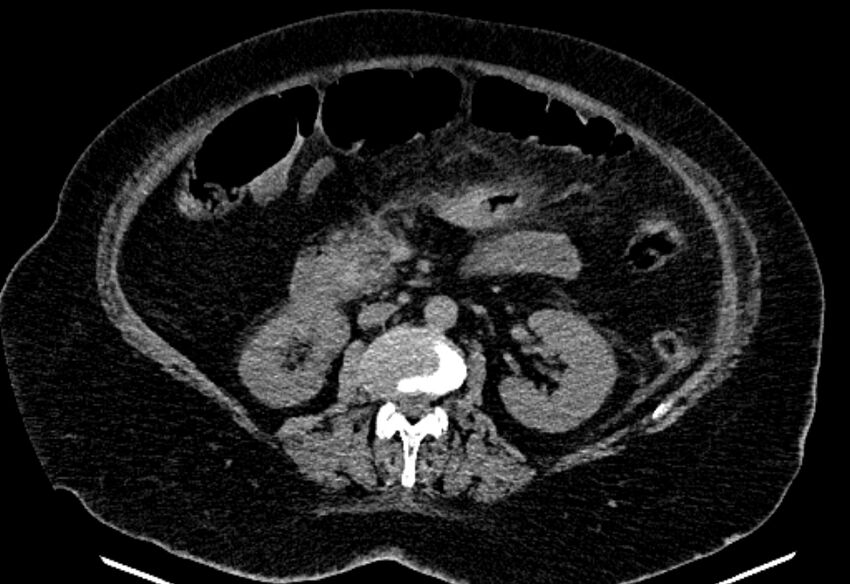 Biliary pancreatitis (Radiopaedia 72289-82823 Axial non-contrast 124).jpg
