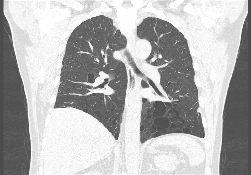 File:Birt-Hogg-Dubé syndrome (Radiopaedia 52578-58491 Coronal lung window 36).jpg