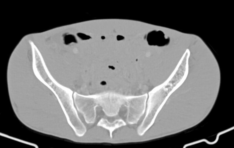 File:Blunt injury to the small bowel (Radiopaedia 74953-85987 Axial Wide 77).jpg