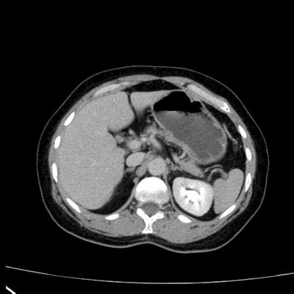 File:Bosniak renal cyst - type I (Radiopaedia 27479-27675 D 7).jpg