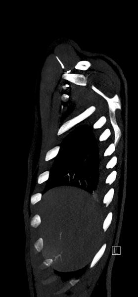 File:Brachiocephalic trunk pseudoaneurysm (Radiopaedia 70978-81191 C 13).jpg