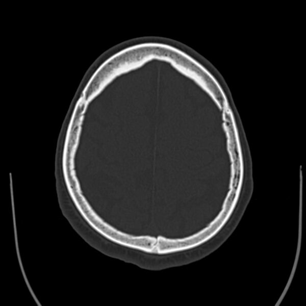 File:Brain Pantopaque remnants (Radiopaedia 78403-91048 Axial bone window 53).jpg