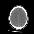 Brain death (Radiopaedia 78597-91360 Axial non-contrast 48).jpg