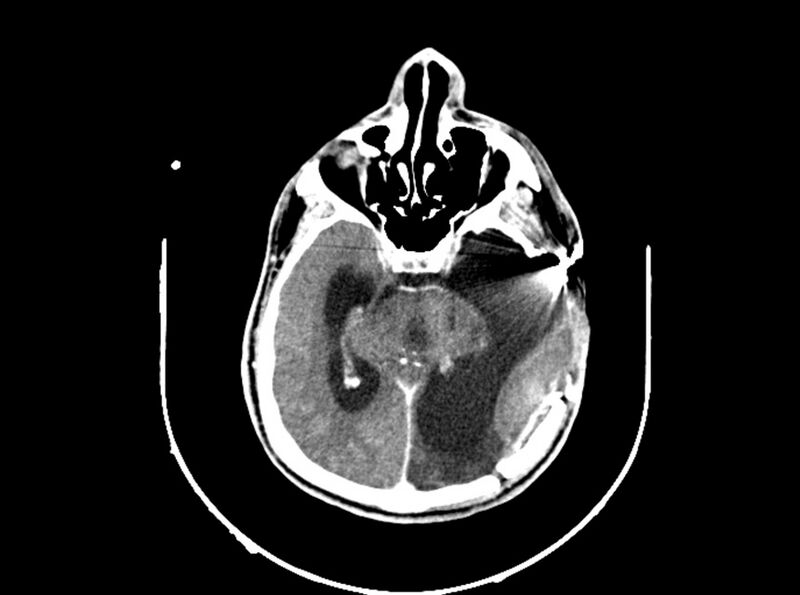 File:Brain injury by firearm projectile (Radiopaedia 82068-96088 B 115).jpg