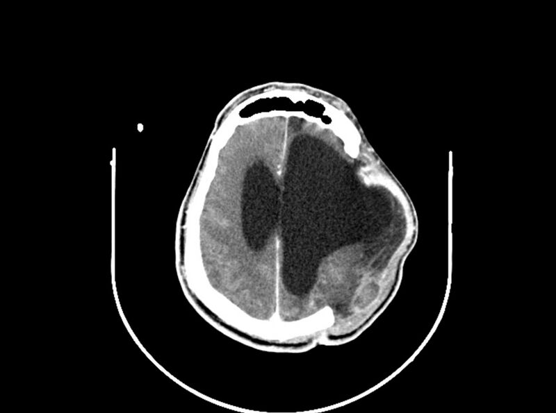 File:Brain injury by firearm projectile (Radiopaedia 82068-96088 B 158).jpg
