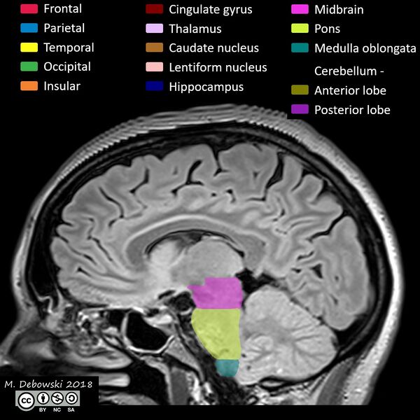 File:Brain lobes - annotated MRI (Radiopaedia 61691-69700 Sagittal 35).JPG