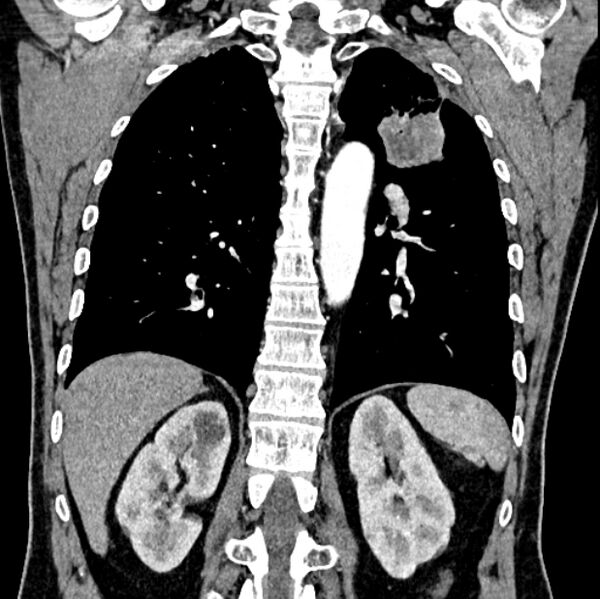File:Brain metastases - lung cancer primary (Radiopaedia 75060-86116 C+ arterial phase 47).jpg