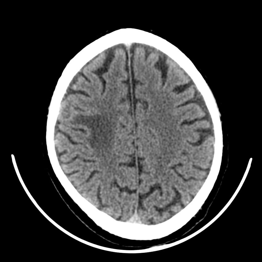 Brain metastasis (Radiopaedia 42617-45760 Axial non-contrast 35).jpg