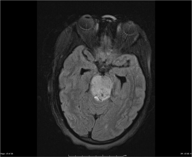 File:Brainstem glioma (Radiopaedia 21819-21775 Axial FLAIR 15).jpg