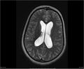 Brainstem glioma (Radiopaedia 21819-21775 Axial T2 24).jpg