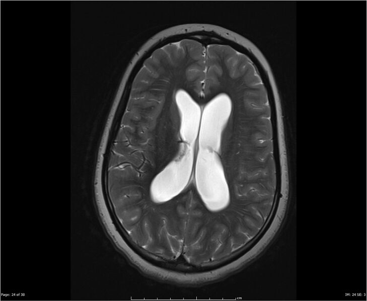 File:Brainstem glioma (Radiopaedia 21819-21775 Axial T2 24).jpg