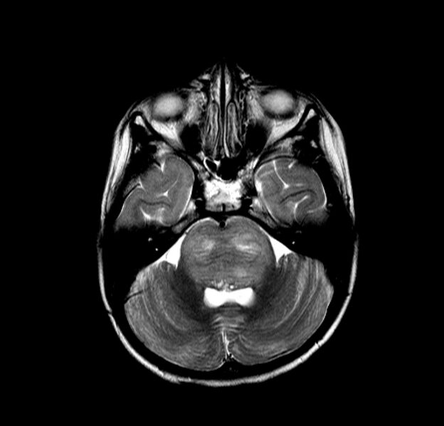 File:Brainstem glioma (Radiopaedia 5683-7390 Axial T2 3).jpg