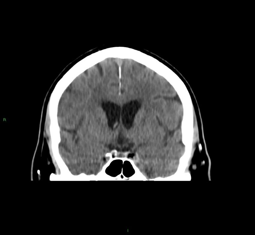 Brainstem hemorrhage (Radiopaedia 58794-66028 Coronal non-contrast 39).jpg