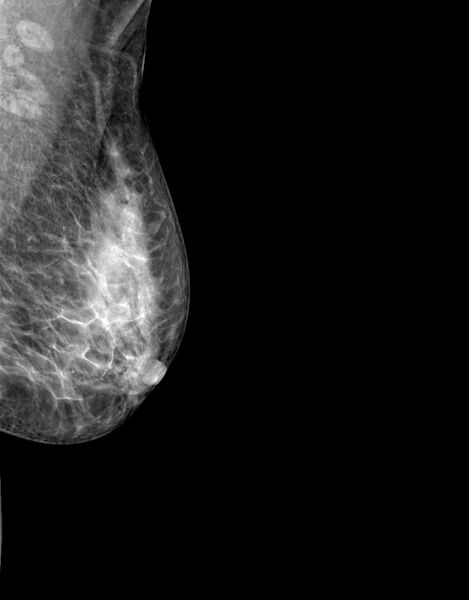 File:Breast ductal carcinoma in situ (Radiopaedia 58329-65447 MLO 1).jpg
