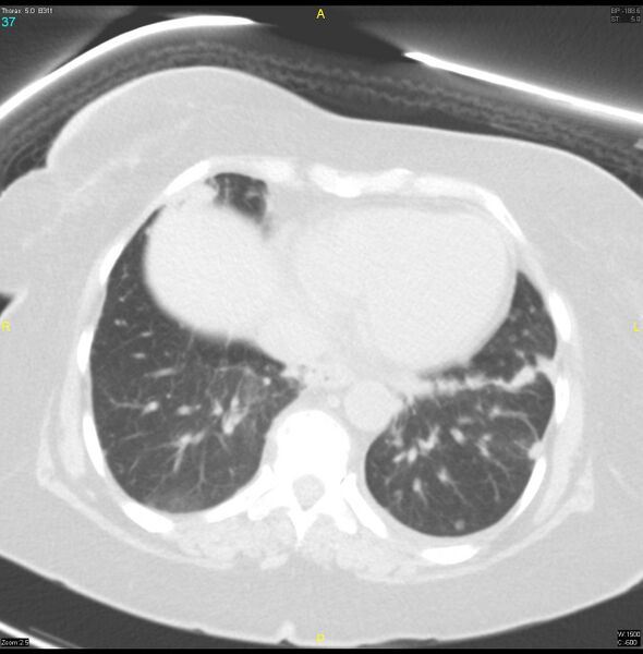 File:Breast primary with lung and bone metastases (Radiopaedia 40620-43228 Axial lung window 37).jpg