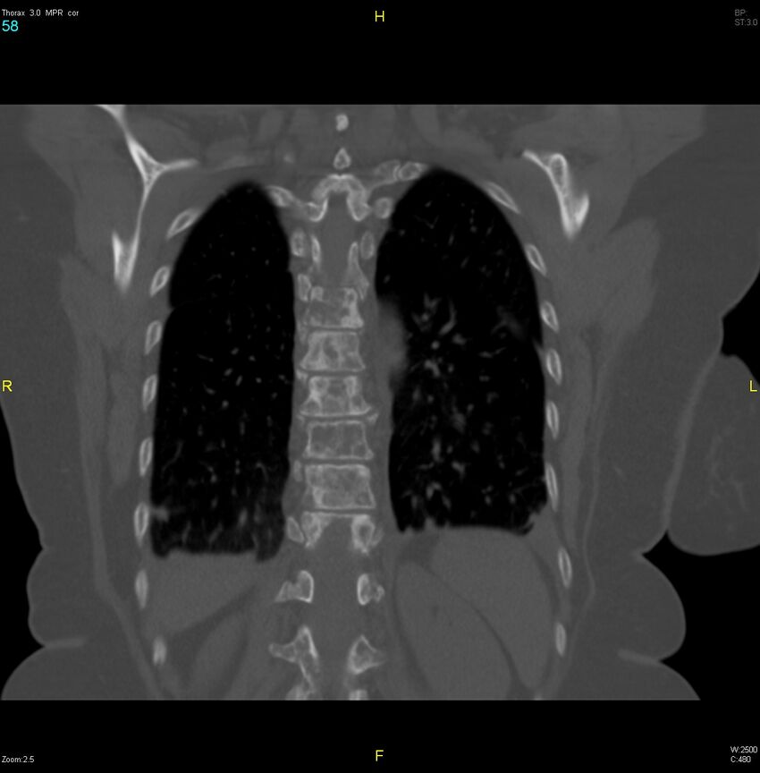 Breast primary with lung and bone metastases (Radiopaedia 40620-43228 bone window 58).jpg