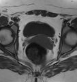 Broad ligament leiomyoma (Radiopaedia 81634-95516 Axial T1 18).jpg