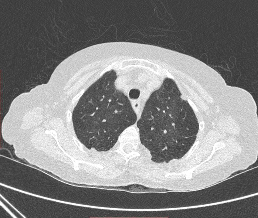 Bronchiectasis (Radiopaedia 72693-83293 Axial lung window 22).jpg