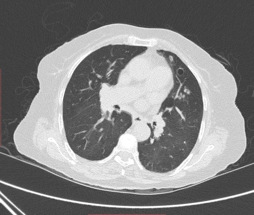 Bronchiectasis (Radiopaedia 72693-83293 Axial lung window 65).jpg