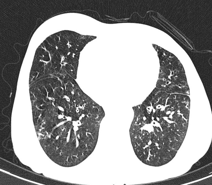 File:Bronchiolitis (Radiopaedia 24616-24887 Axial lung window 40).jpg