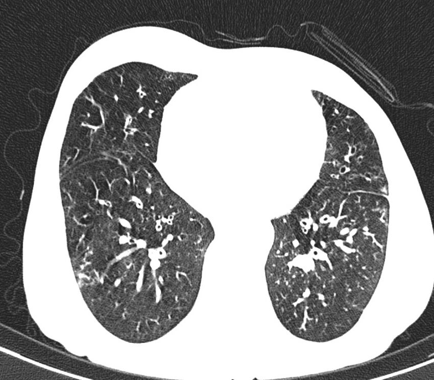 Bronchiolitis (Radiopaedia 24616-24887 Axial lung window 40).jpg
