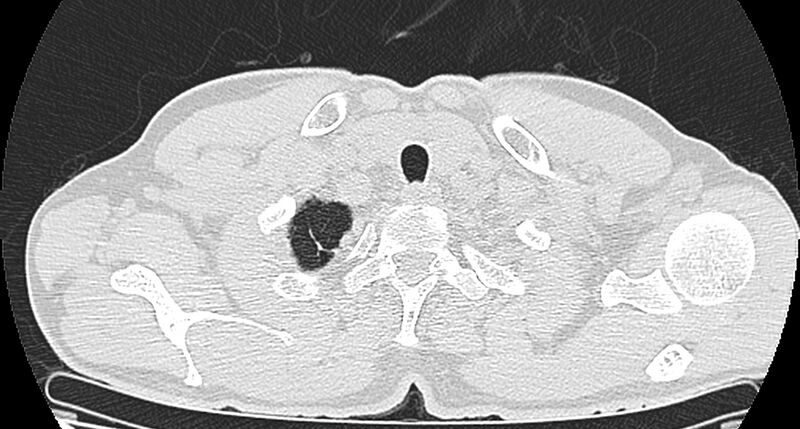 File:Bronchogenic carcinoma with superior vena cava syndrome (Radiopaedia 36497-38054 Axial lung window 3).jpg