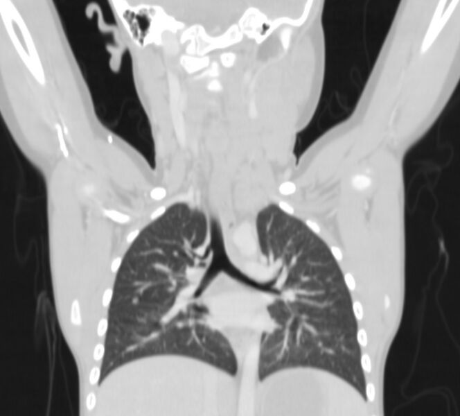 File:Bronchus suis (Radiopaedia 68131-77620 Coronal lung window 12).jpg