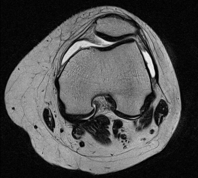 File:Bucket handle tear - medial meniscus (Radiopaedia 79028-91942 Axial T2 18).jpg